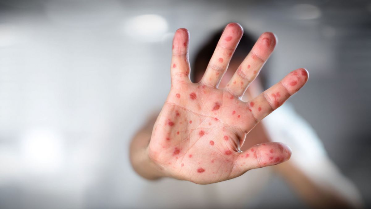 Rujeola mai face o victimă: un bebeluș a murit răpus de boală. Doctorii spun că nu era vaccinat