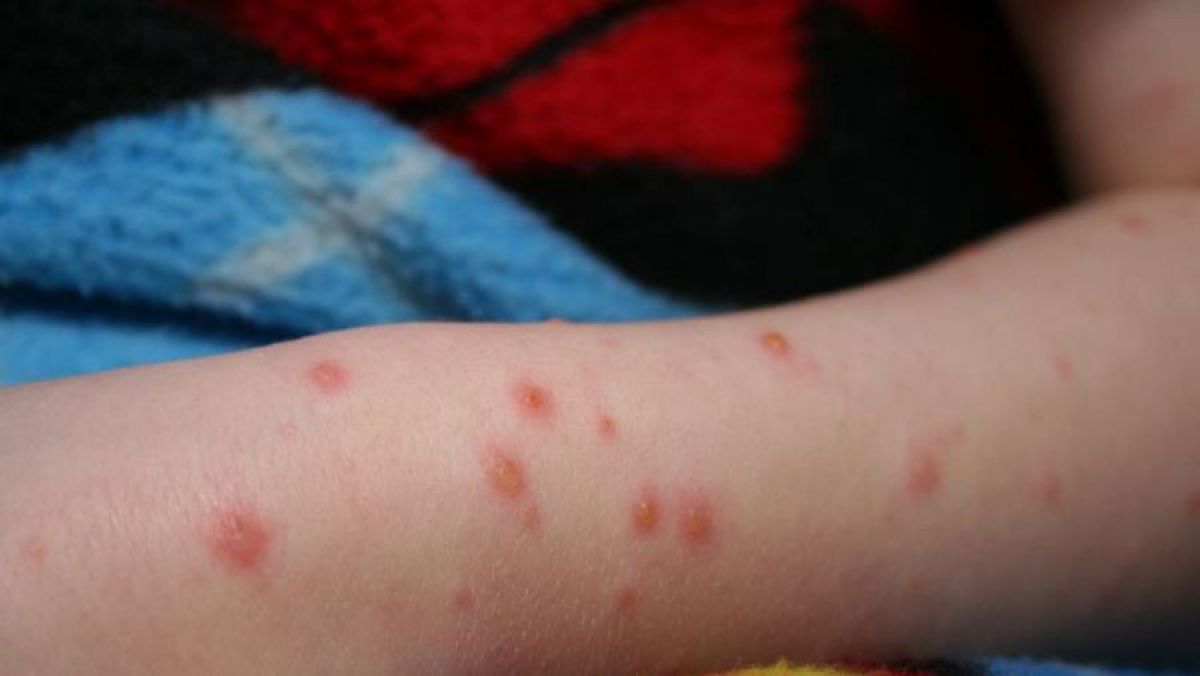 Aproape 5.000 de copii nu au fost primiți la școală pentru că nu au vaccinul ROR. Cum a evoluat numărul de bolnavi