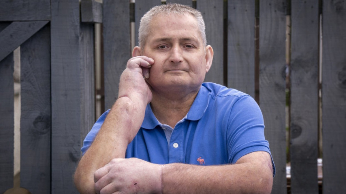 În premieră în lume, un bărbat a suferit dublu transplant de mâini, după o afecțiune autoimună