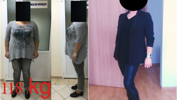 Mărturiile unei moldovence care și-a făcut operație de micșorare a stomacului: Nu am spus nimănui și continuu să mint