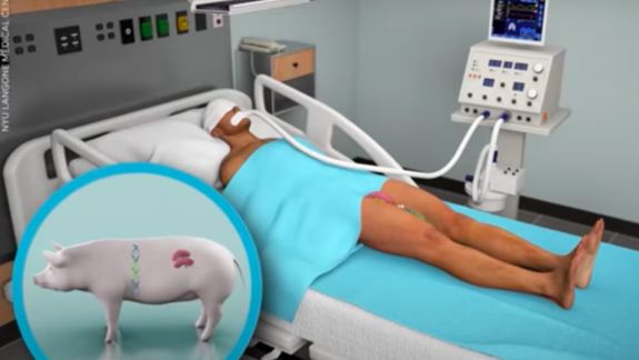 Premieră pentru lumea medicală:  Chirurgi americani au transplantat cu succes un rinichi de porc la un pacient uman (VIDEO)